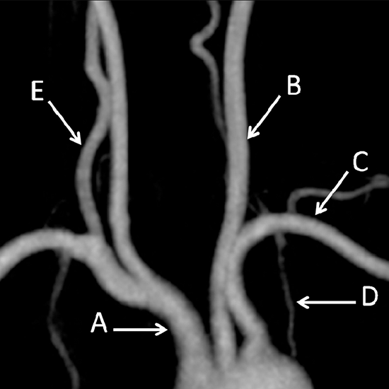 mr angiography aortic arch